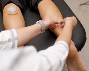 Read more about the article Cupping Technique