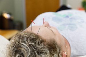 Read more about the article Acid Reflux & Acupuncture